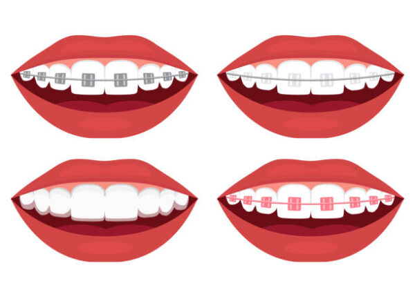 Types of braces