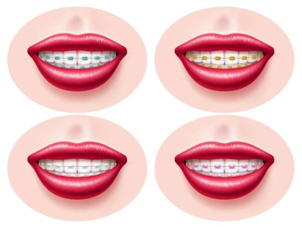 Types of braces
